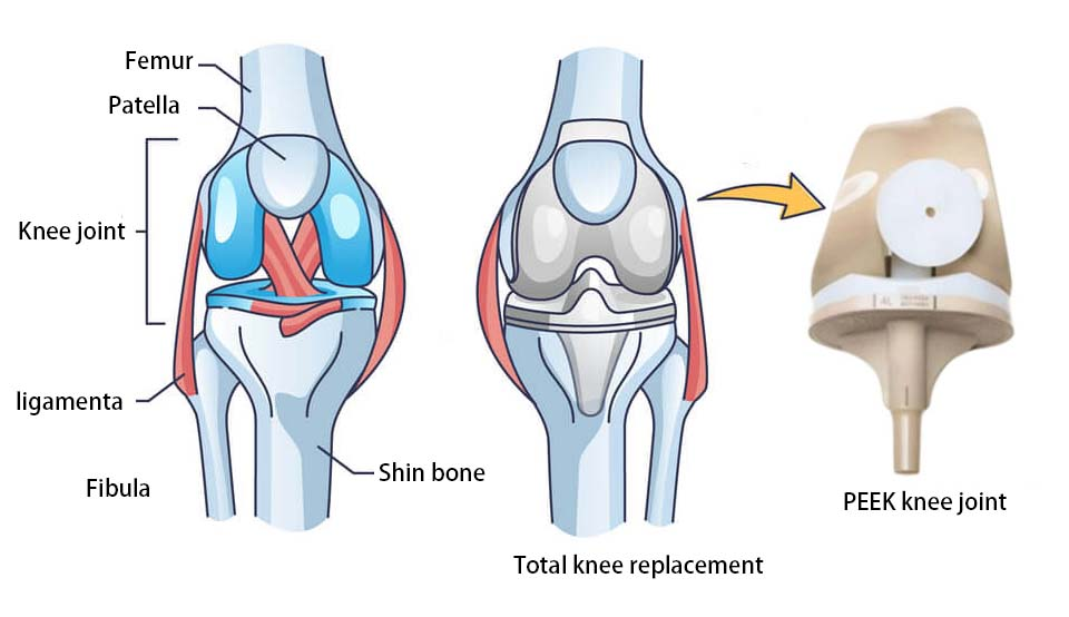 Junsun artificial joints 4